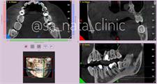Computed tomography of teeth