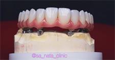Знімне протезування зубів