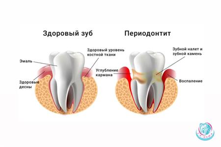 Symptoms of acute periodontitis: