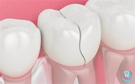 What causes cracks in tooth enamel?