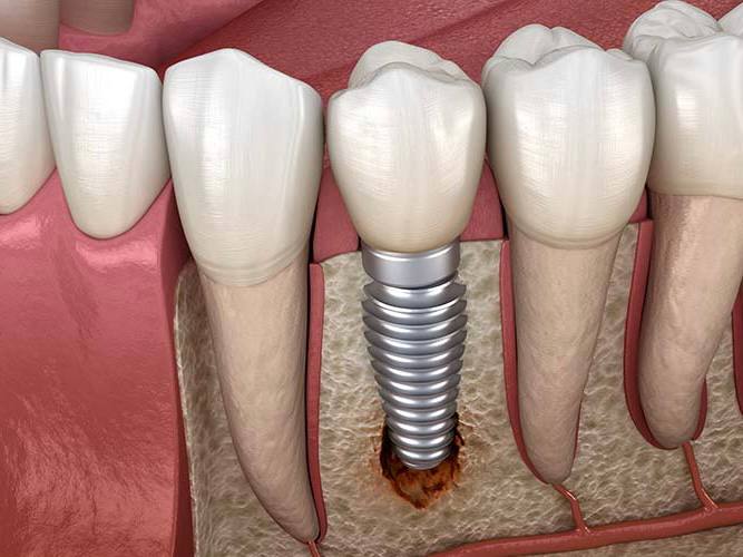 Вероятность отторжения зубного импланта