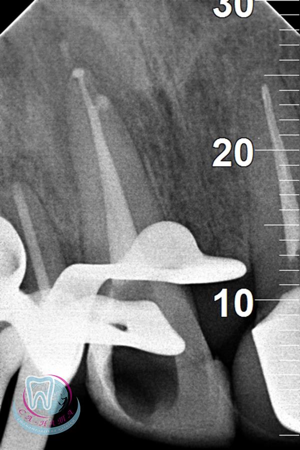 Рентгенографія. Діагностика зубів в клініці "Са-Ната"