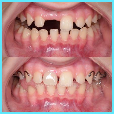 детское протезирование