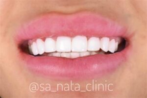 реставрація