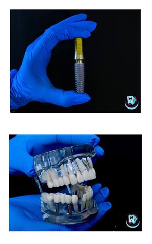 імплантація