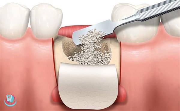 имплантация