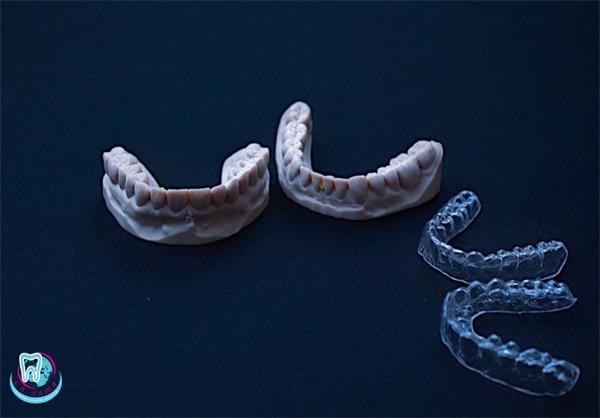 В каких случаях назначают элайнеры? 