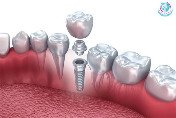 имплантация