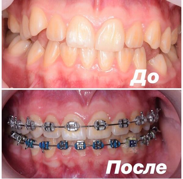 Сроки ношения брекетов у взрослых 