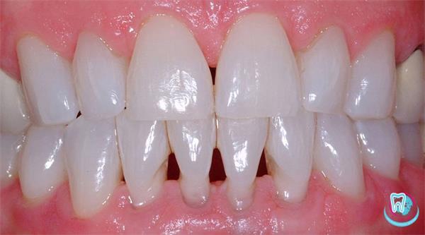 рецессия десны