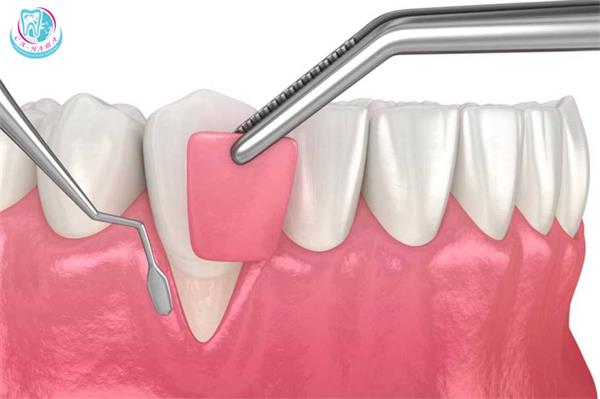 рецессия десны