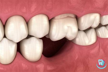 рецессия десны