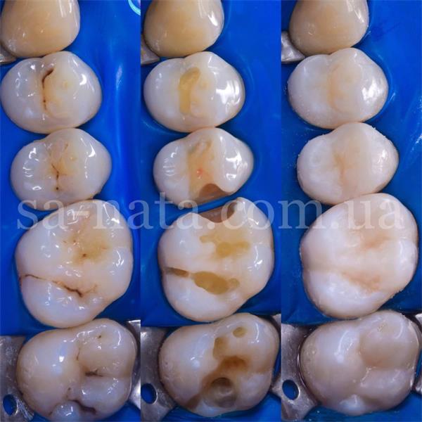 В каких случаях необходимо ставить фотополимерную пломбу?