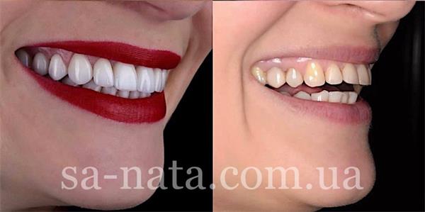 Преимущества коронки из керамики: